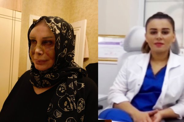 "Gözəllik Qurban tələb edir" yoxsa "N-LAZ" Tibb Mərkəzinin həkimi Op.Dr. Esmira İbrahimova həqiqətən də "QURBAN" edir? FAKT/İDDİA. FOTOLAR. - YENİLƏNİB