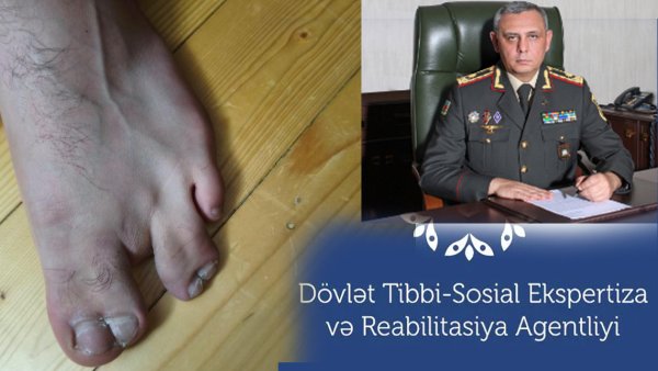 Ayağında 3 barmağı var, onlar da yararsız - Hərbi xidmətə göndərdilər